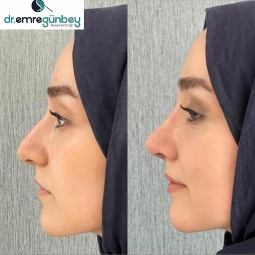 Blépharoplastie Photo avant/après
